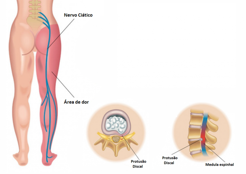 Como identificar se sua dor na perna é causada por um problema na coluna